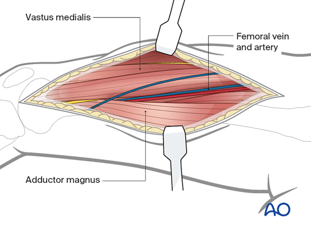 Identifying the vastus medialis and adductor magnus