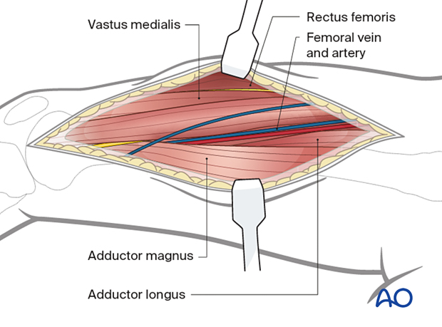 Identify the vastus medialis, rectus femoris, and adductor longus and adductor magnus. Identify and protect the femoral artery and vein.
