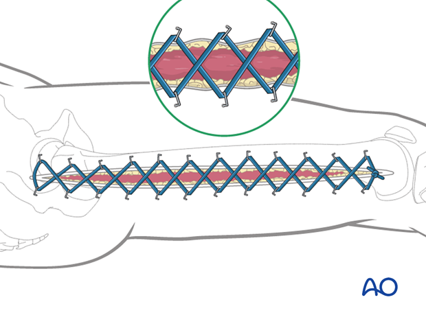 Compartment syndrome in the thigh – use of elastic retention sutures