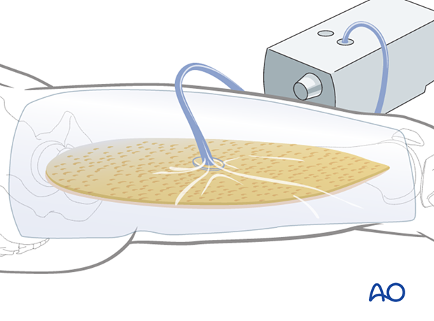 Compartment syndrome in the thigh – use of a wound vacuum-assisted closure (VAC) device