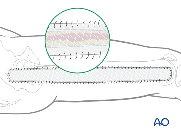 Compartment syndrome in the thigh – delayed soft-tissue management: secondary coverage