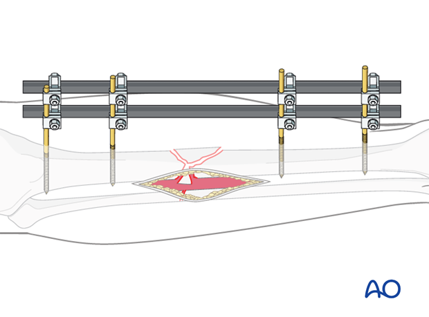 The diagram demonstrates an ideal external fixation placement.