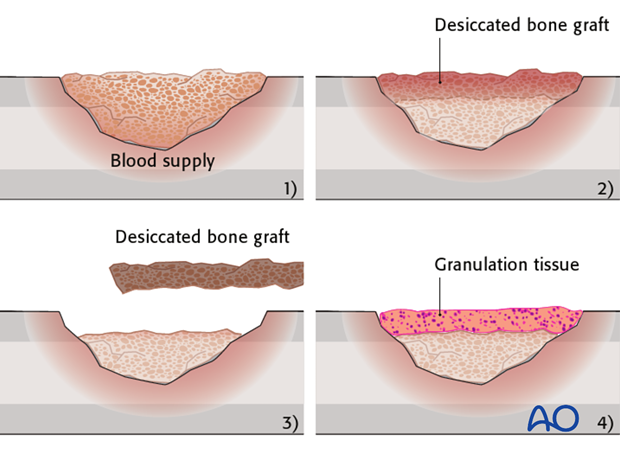 Open cancellous bone grafting (Papineau technique), leaving the graft exposed beneath a nonadherent dressing, is a well-tried...