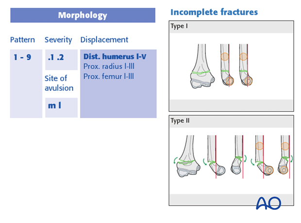 classification of childrens fractures