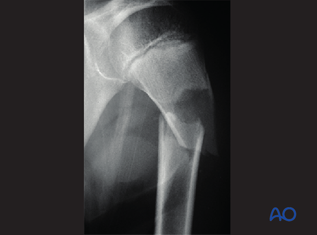 fractures in abnormal bone