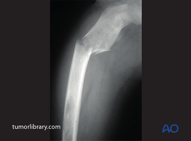fractures in abnormal bone