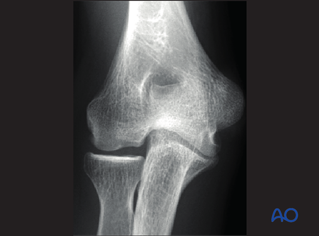 posttraumatic growth disturbance