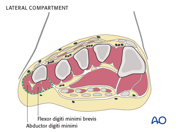 compartment syndrome