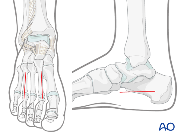 compartment syndrome