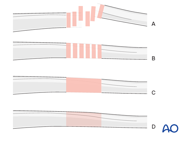 Generic fracture patterns used in this procedure