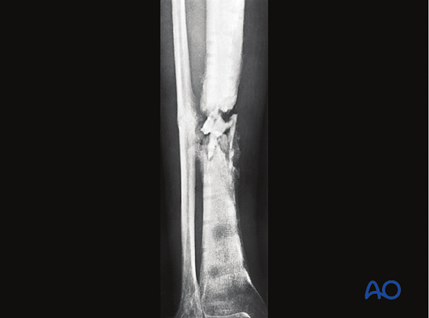 Chronic fracture site infection