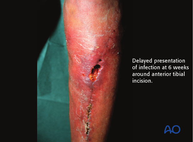 Some fracture wound infections present more than 2 weeks after fracture surgery.