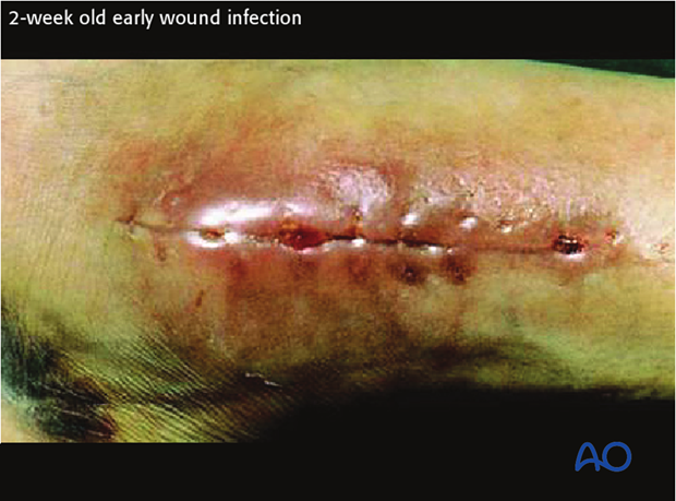 Early infections generally occur less than 2 weeks after surgery. 