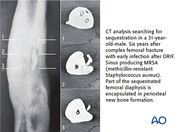 Cross-sectional imaging (CT, or MRI) helps to detect and locate sequestra and necrotic bone. 