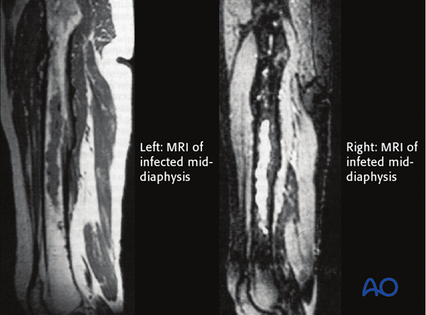 MRI offers improved imaging of soft-tissue abnormalities and can show greater anatomical detail than other imaging methods.