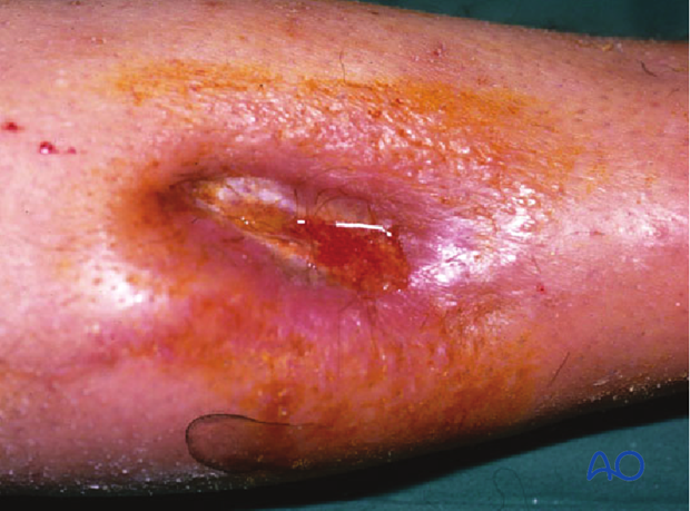 Fracture-Related Infection of the tibia due to a polymicrobial