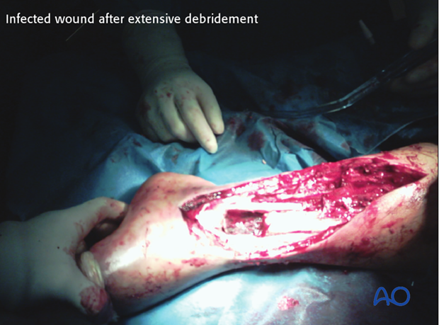 Infected wound after extensive débridement
