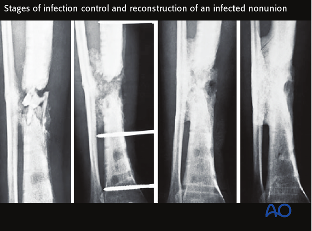 Eradication of infection, restoration of stability, and soft-tissue closure should be achieved before limb reconstruction. 