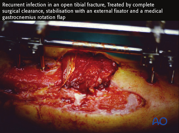 Recurrent infection in an open tibial fracture