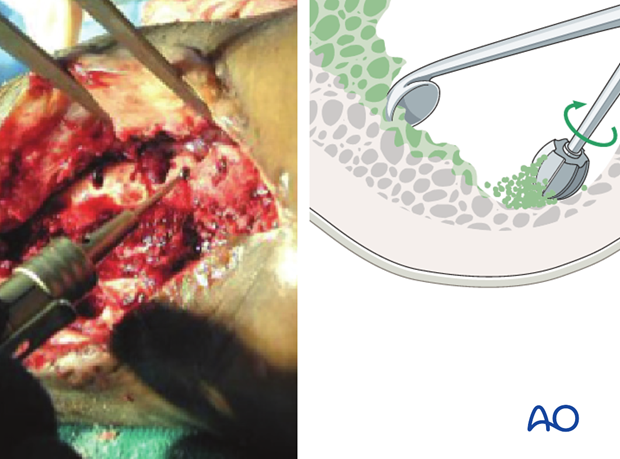 Excise the surface of the exposed tissue to leave clearly viable margins of subcutaneous tissue, fascia and muscle.