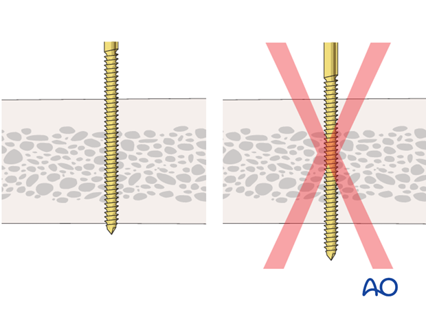 basic technique modular external fixation