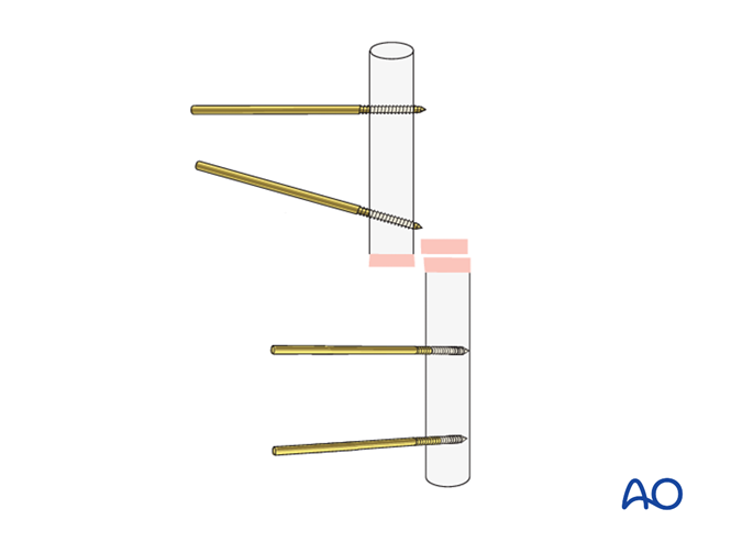 Modular external fixation