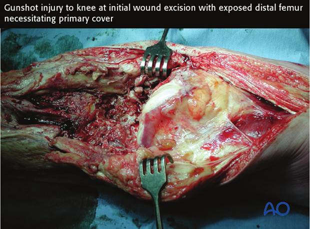 When an open fracture communicates with a joint cavity, special surgical tactics are required.