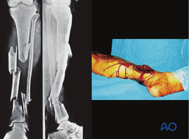 These illustrations show a severe open segmental tibial fracture, in which, short of primary amputation, IMN, using an ...