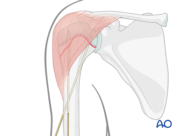 K-wire insertion for proximal subcapital humeral fractures