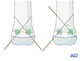 general k wire principles