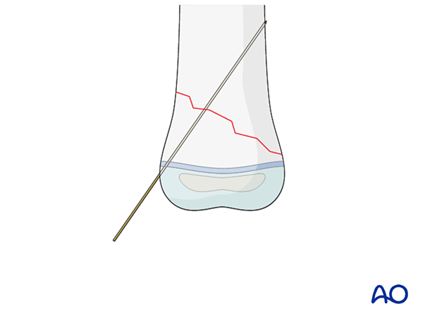 K-wire fixation of an oblique metaphyseal fracture in a pediatric patient