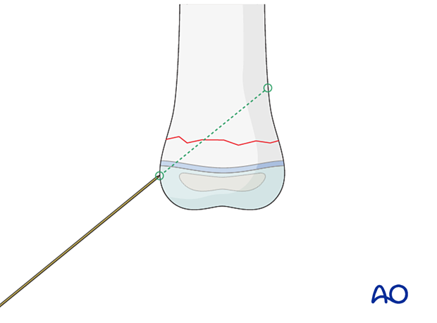 K-wire fixation of a transverse metaphyseal fracture in a pediatric patient