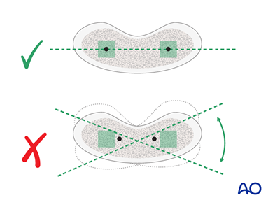 General K-wire principles