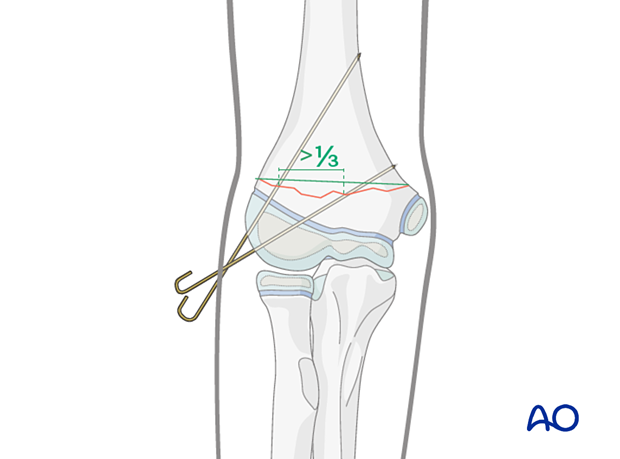 Monolateral divergent K-wires in oblique fractures