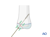 Lag screws
