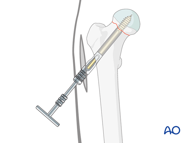 Screw insertion in proximal femoral fractures