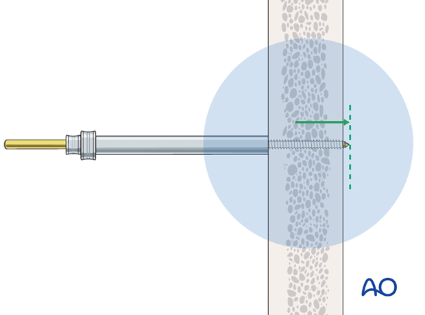 Pin insertion (conventional threaded pins)