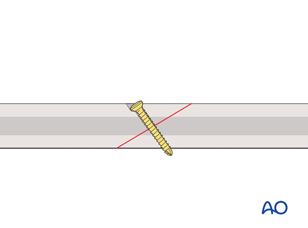 Lag screw fixation of an oblique shaft fracture