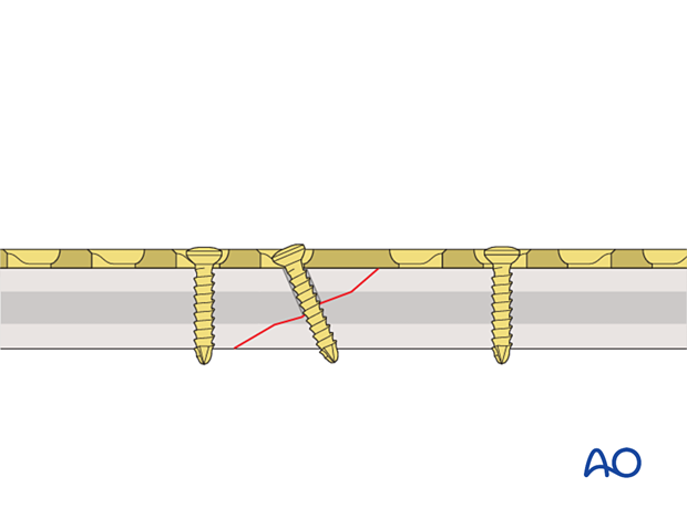 Insertion of a lag screw through the plate for plating an oblique shaft fracture