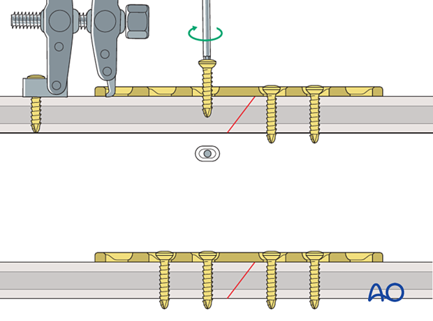 Plating of an oblique shaft fracture with an articulated tension device
