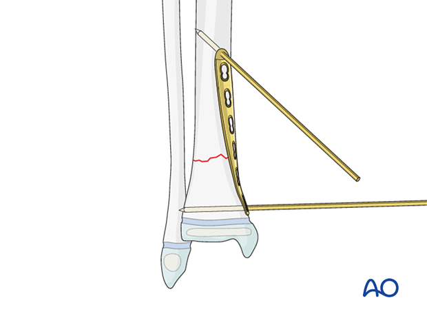 Plate placement for fixation of a simple fracture of the pediatric distal tibia