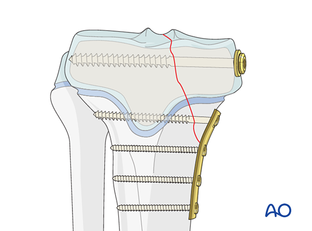 Butress plating of a partial articular fracture of the pediatric proximal tibia