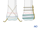 K-wire and plate fixation of a pediatric metaphyseal fracture