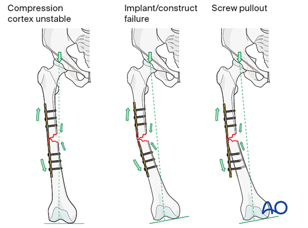 If there is insufficient support on the compression side an implant used as a tension band may fail due to implant fatigue. If bone quality is poor the fixation may fail by pullout of the implant from the bone.