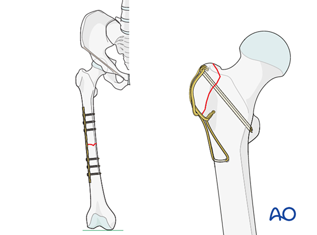 Tension bands applied to the lateral side of the femur and the greater trochanter.