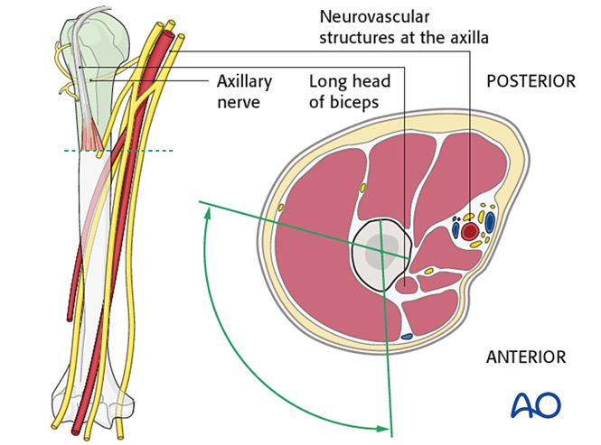 MIO - Screw fixation for Extraarticular 2-part, greater tuberosity ...