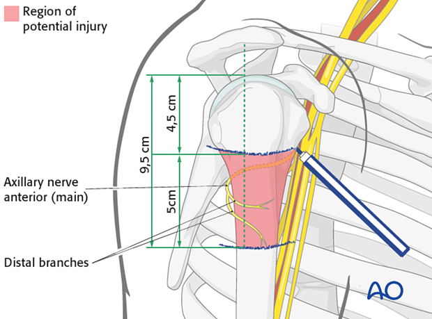 The axillary nerve should be protected by limiting the incision to less than 5 cm distal to the acromial edge.