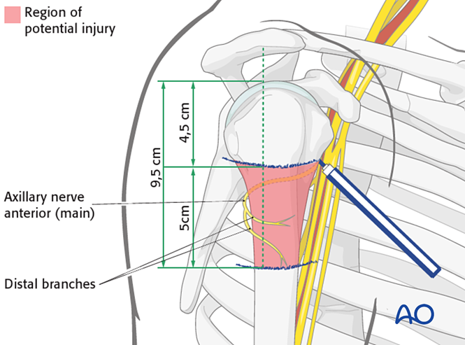 Transdeltoid lateral approach to the proximal humerus