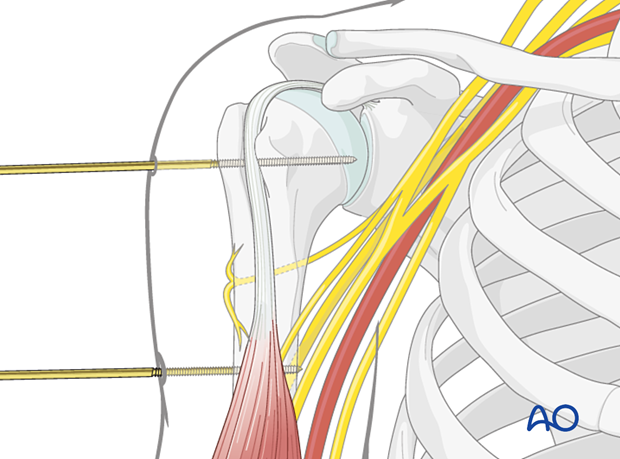 The tips of the pins in the humeral shaft should just perforate the far cortex.