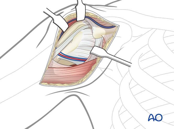 ORIF - Plate fixation for 4-Part, dislocation, simple metaphyseal ...